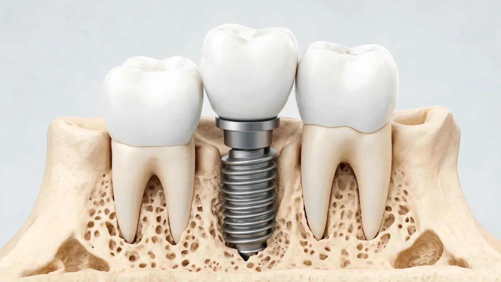 Illustration of a dental implant in the lower jaw: a titanium post in the bone, an abutment and a porcelain crown between natural teeth