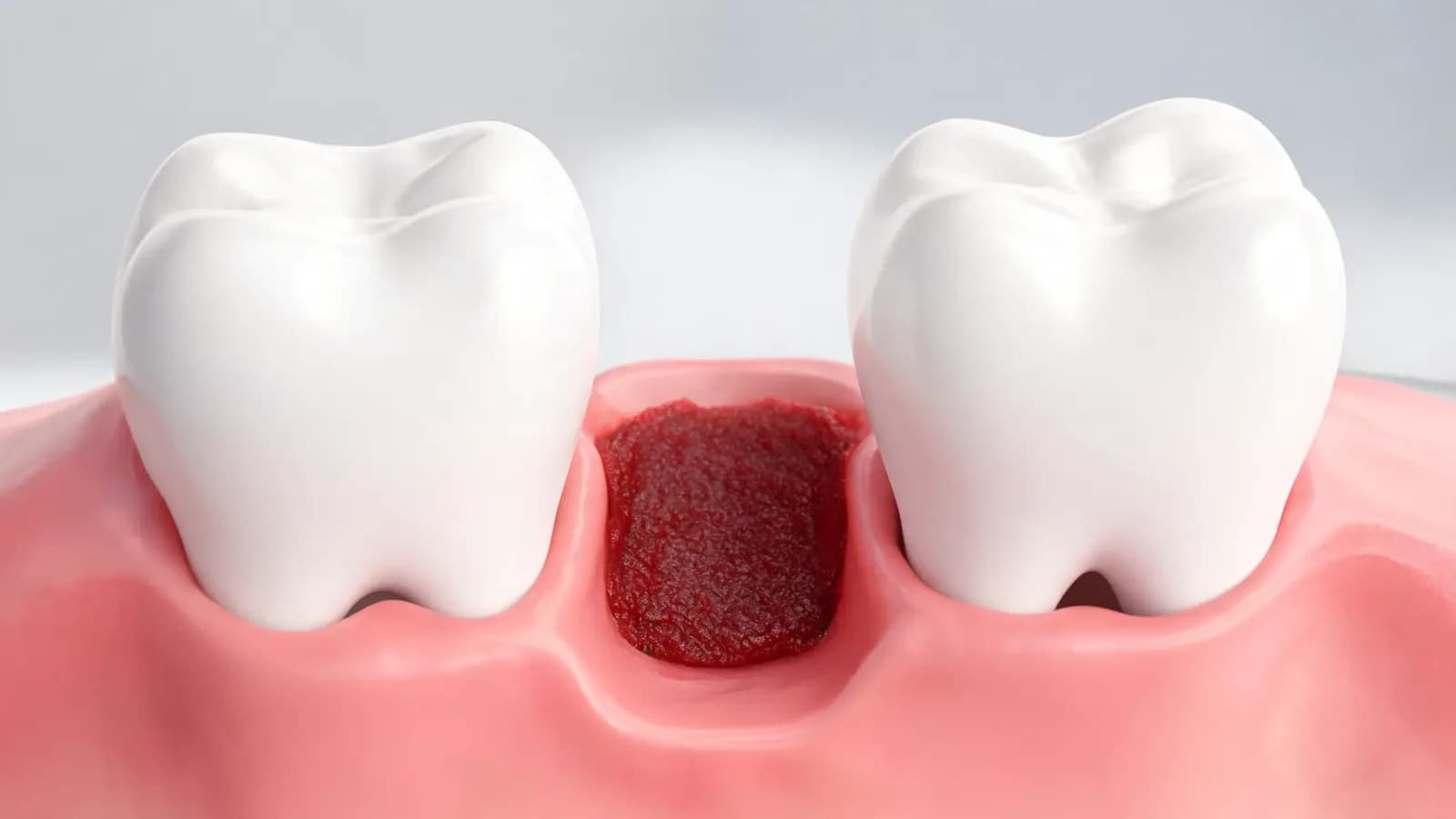 Illustration of a healing tooth extraction site with a protective blood clot filling the socket between two healthy teeth
