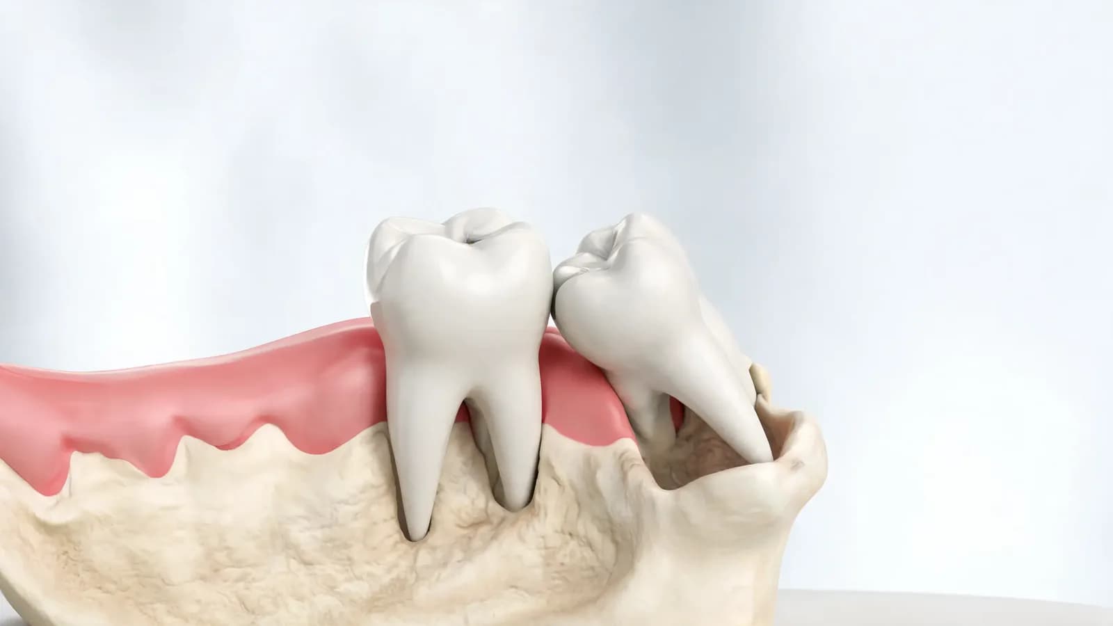 Illustration of a lower jaw with an impacted wisdom tooth tilted against the neighboring second molar